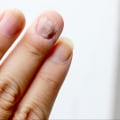 Nail Mold vs Fungus: The Definitive Guide You Need Today