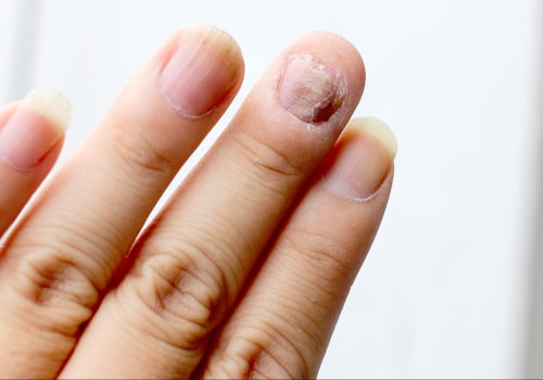 Nail Mold vs Fungus: The Definitive Guide You Need Today